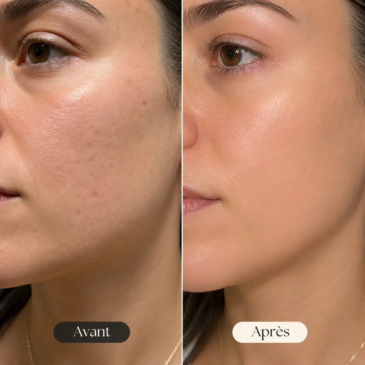 Avant-après Anouvia — grain de peau lissé et rougeurs atténuées sur la joue