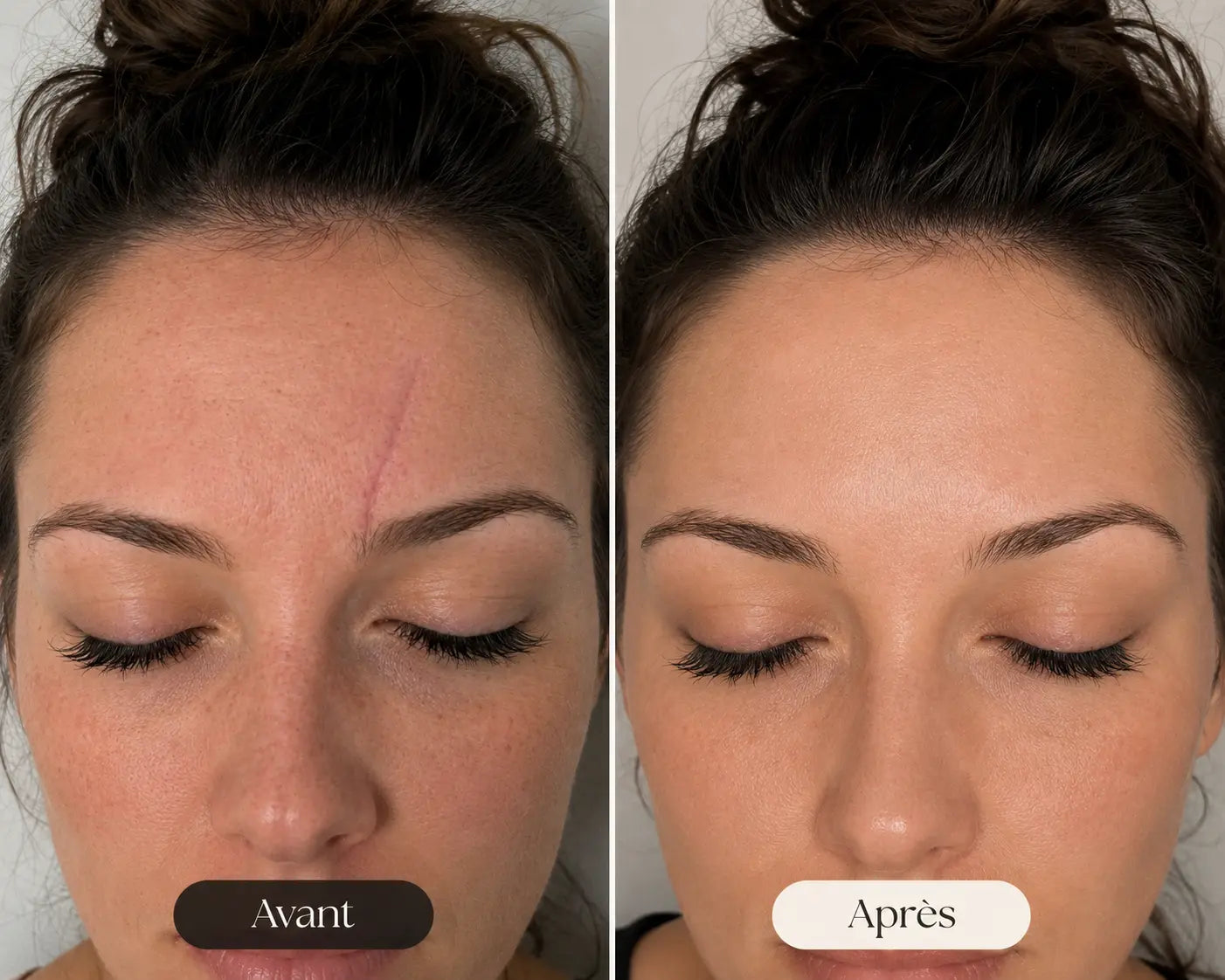 Avant-après bande silicone Anouvia — cicatrice du front visiblement atténuée